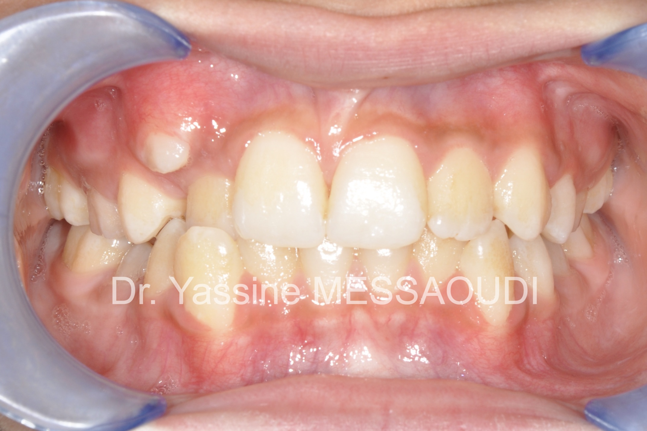 Adolescent - Avant traitement